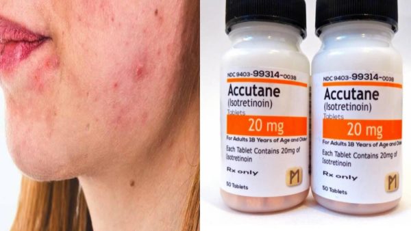 Accutane (Isotretinoin) Packung – Medikament zur Behandlung von schwerer Akne